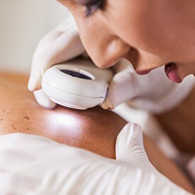 Performed to remove skin lesions on the face and body, cryotherapy works through liquid nitrogen to freeze and destroy a variety of skin growths.